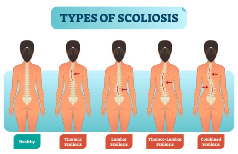 Scoliosis and Medical Fitness