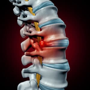 Herniated and Bulging Discs and Yoga Therapy